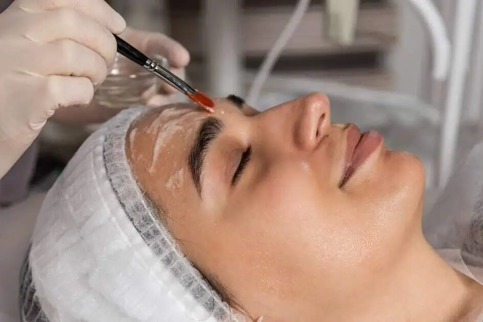 Chemical peels